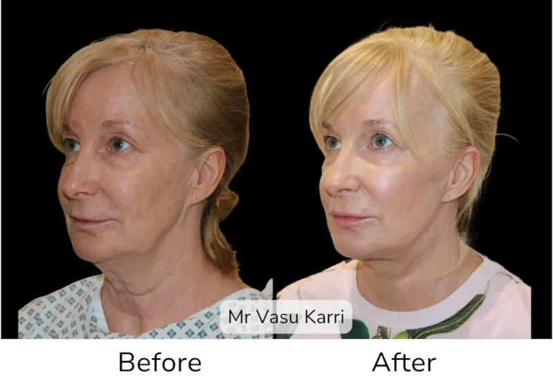 Facelift Patient 17 View 2